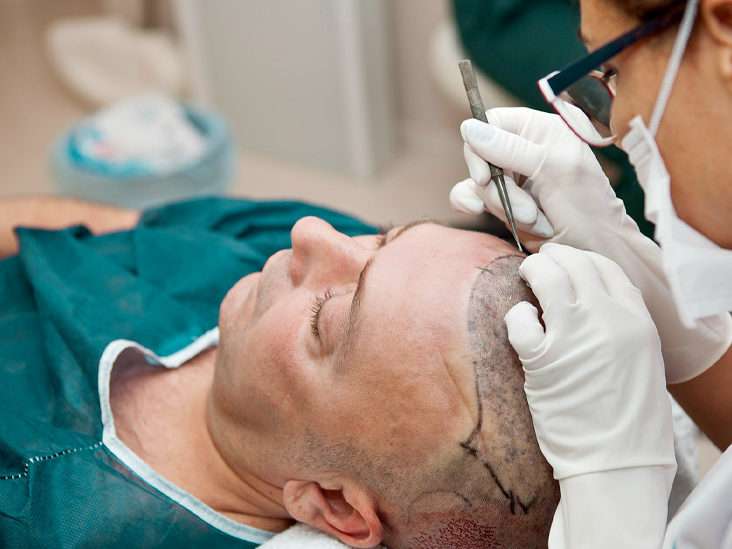 Which is the Best Hair Transplant Clinic in Turkey