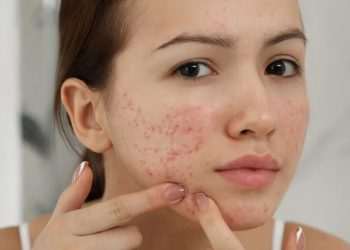 Will get rid of blackheads in the heat now, just sit at home this treatment