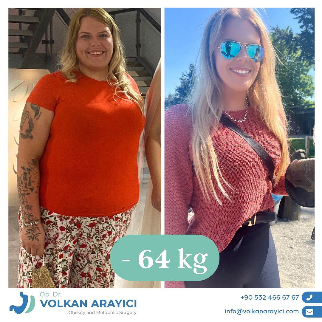 Gastric Sleeve Turkey: Cost, Clinics, and Comprehensive Guide